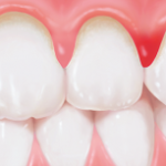 菊名の歯医者、ココセトデンタルクリニックで歯周病の急性発作についての解説