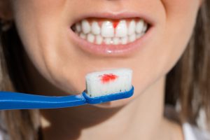 菊名の歯科、歯医者、ココセトデンタルクリニックで黒い歯石について解説