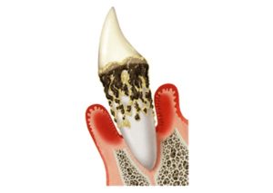 菊名の歯科、歯医者、ココセトデンタルクリニックで黒い歯石について解説