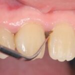 菊名の歯科、歯医者、ココセトデンタルクリニックで黒い歯石について解説
