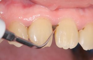 菊名の歯科、歯医者、ココセトデンタルクリニックで黒い歯石について解説
