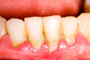 菊名の歯科、歯医者、ココセトデンタルクリニックで黒い歯石について解説