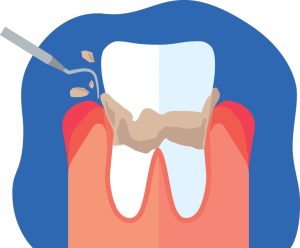 菊名の歯科、歯医者、ココセトデンタルクリニックで黒い歯石について解説