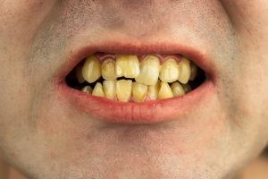 菊名の歯科、歯医者ならココセトデンタルクリニックで30代からのデンタルケアについての解説