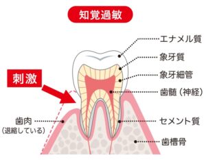 菊名の歯科、歯医者ならココセトデンタルクリニックで知覚過敏についての解説