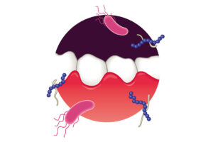 菊名の歯医者、ココセトデンタルクリニックで歯周病の急性発作についての解説
