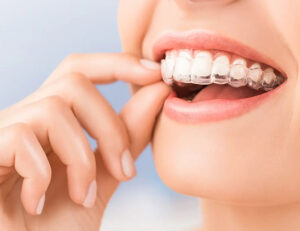 菊名の歯医者、ココセトデンタルクリニックで歯科矯正中の食事のポイントと治療をスムーズに進めるためのコツを解説